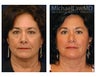 Facial Rejuvenation