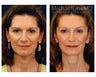 Facial Rejuvenation
