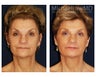 Facial Rejuvenation
