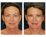 Facial Rejuvenation