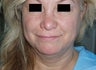 Mini Lift under local anesthesia