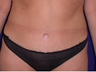 Mini Tummy Tuck