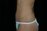 Mini Tummy Tuck