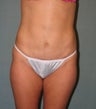 Mini Tummy tuck