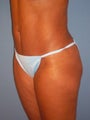 Mini Tummy Tuck