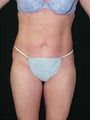 Mini Tummy Tuck