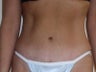 Mini Abdominoplasty