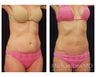 Abdominoplasty - Tummy Tuck