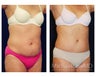 Abdominoplasty - Tummy Tuck