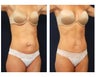 Abdominoplasty - Tummy Tuck