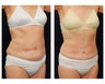Abdominoplasty - Tummy Tuck