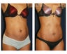 Abdominoplasty - Tummy Tuck