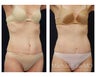 Abdominoplasty - Tummy Tuck