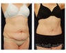 Abdominoplasty - Tummy Tuck