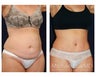 Abdominoplasty - Tummy Tuck