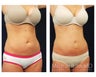 Abdominoplasty - Tummy Tuck