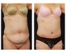 Abdominoplasty - Tummy Tuck