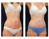 Abdominoplasty - Tummy Tuck