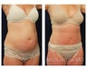 Abdominoplasty - Tummy Tuck