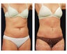 Abdominoplasty - Tummy Tuck