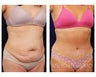 Abdominoplasty - Tummy Tuck