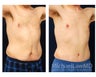 Abdominoplasty - Tummy Tuck