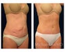 Abdominoplasty - Tummy Tuck