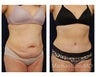 Abdominoplasty - Tummy Tuck