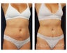 Abdominoplasty - Tummy Tuck