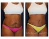 Abdominoplasty - Tummy Tuck