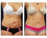 Abdominoplasty - Tummy Tuck