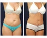 Abdominoplasty - Tummy Tuck