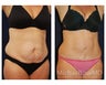 Abdominoplasty - Tummy Tuck