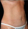 Mini Tummy Tuck