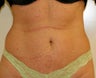 Mini-abdominoplasty
