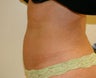 Mini-abdominoplasty