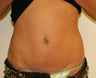 Mini-abdominoplasty