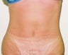Mini-abdominoplasty
