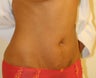 Mini-abdominoplasty