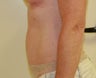 Mini-abdominoplasty