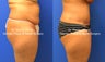 Mini Tummy Tuck