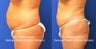 Mini Tummy Tuck