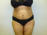 Mini Tummy Tuck and liposuction