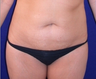 Mini Tummy Tuck