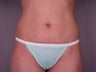 Mini Tummy Tuck