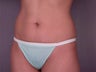 Mini Tummy Tuck