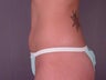 Mini Tummy Tuck