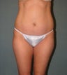 Mini Tummy tuck