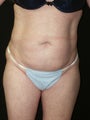 Mini Tummy Tuck