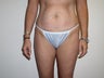 Mini Abdominoplasty